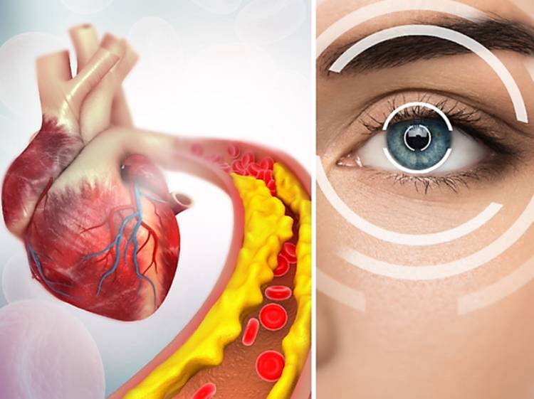 4 Tanda Penyakit Jantung yang Bisa Anda Lihat  pada Mata 