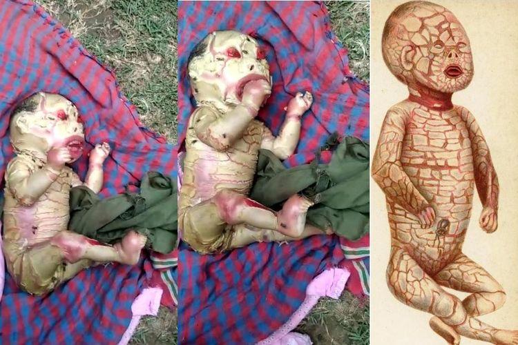 Video Bayi Aneh di India, Nama Kondisinya Harlequin Ichthyosis